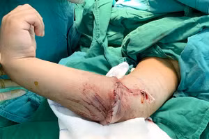 Bệnh nhi ở Long An đứt lìa tay phải đã qua cơn nguy kịch và đang trong quá trình phục hồi (Ảnh: BVCC).