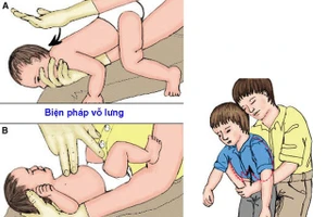 Các biện pháp sơ cứu khi hóc dị vật (MH)