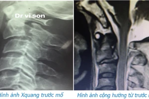 Ảnh chụp X quang và cộng hưởng từ trước khi phẫu thuật (BVCC).