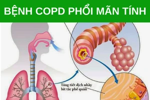 Bệnh phổi tắc nghẽn mãn tính (COPD): Dấu hiệu và cách phòng tránh (Ảnh MH).