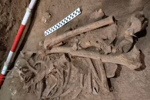 Phát hiện bằng chứng ca phẫu thuật chân sớm nhất trong lịch sử