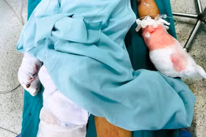 Nam sinh bị nát bàn tay khi chế tạo pháo. (Ảnh: BV cung cấp)