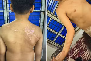 Cháu N.Đ.B.K có 21 vết sẹo và 20 vết rối loạn sắc tố da màu nâu.