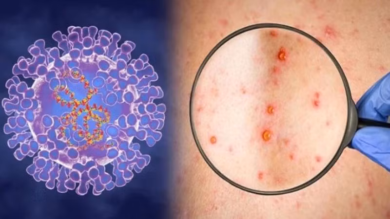 Cà Mau ra văn bản hỏa tốc tăng cường phòng, chống bệnh đậu mùa khỉ