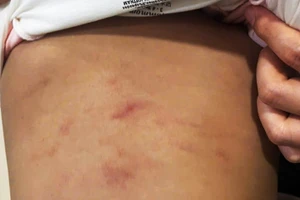 Vết thương trên mình cháu bé bị bạo hành.