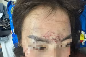 Khuôn mặt chị P.H.M có nhiều vết thương sau khi bị hành hạ.