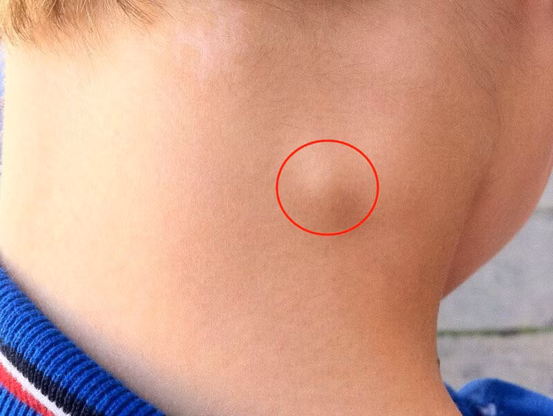 dau-hieu-tren-co-canh-bao-khoi-u-phat-trien-02