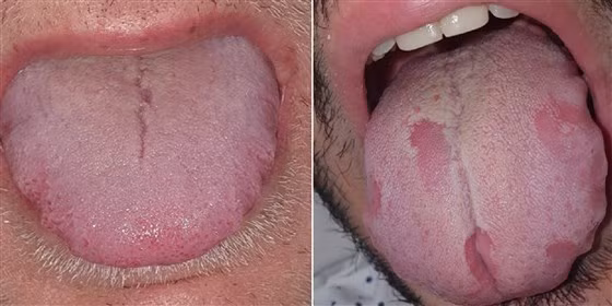 Các dấu hiệu ở lưỡi của người bị mắc Covid-19.