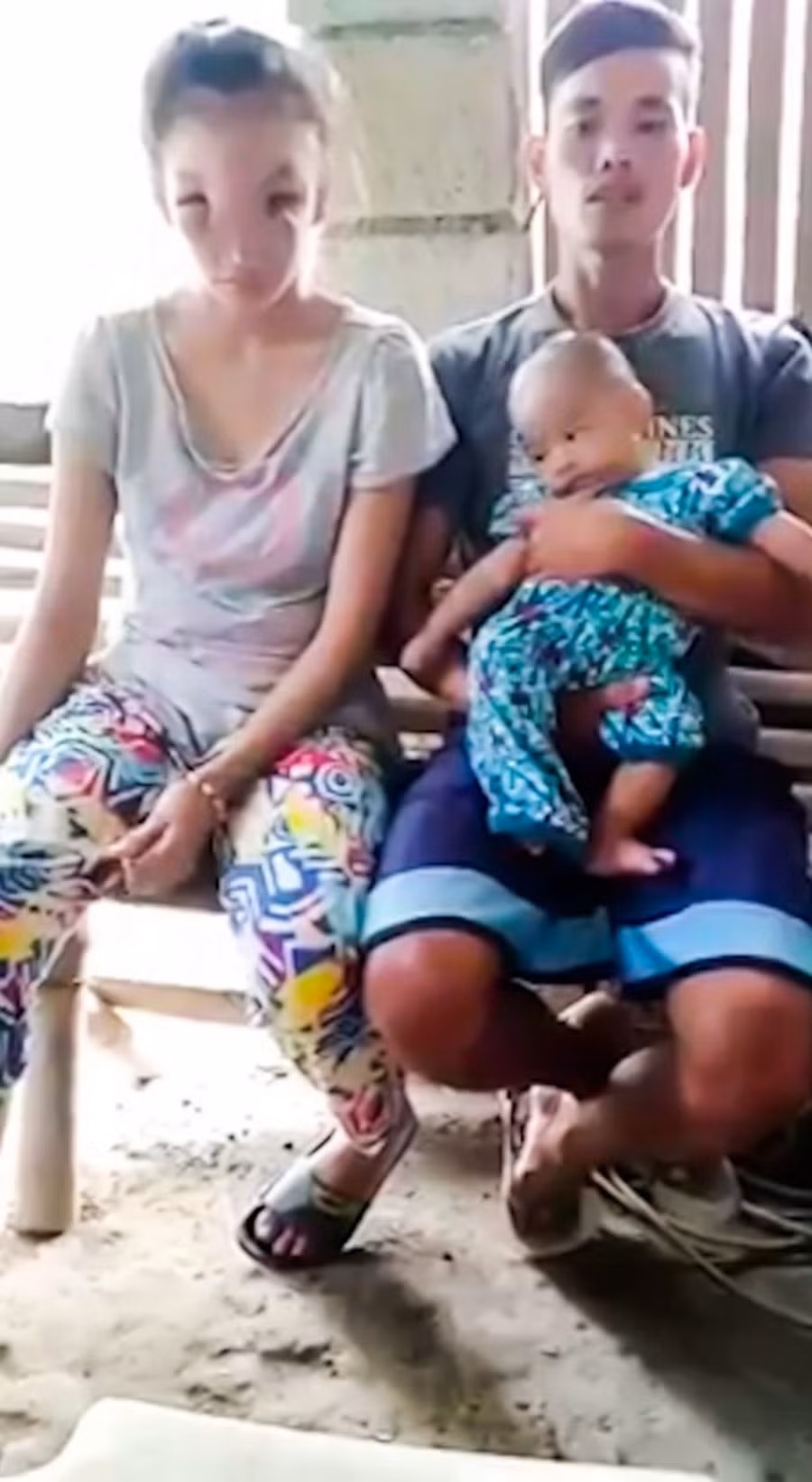 Sức khỏe - Thiếu nữ xinh đẹp mắc bệnh lạ suốt 1 năm sau khi nặn mụn (Hình 3).