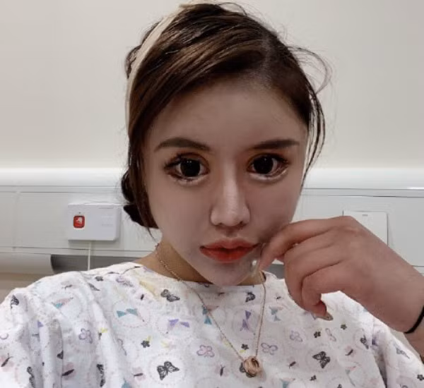 Na Na trải qua tổng cộng hơn 100 cuộc phẫu thuật thẩm mỹ lớn nhỏ tính đến năm 13 tuổi.