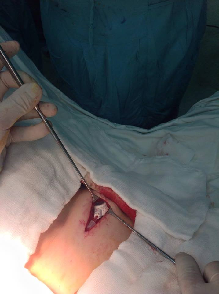 Việc thực hiện phương pháp mới này trải qua nhiều quá trình phức tạp