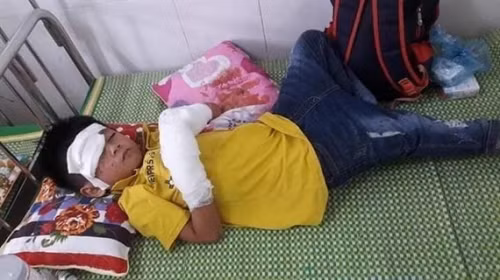 Bé trai 7 tuổi nghịch điện thoại phát nổ bị dập nát 2 bàn tay