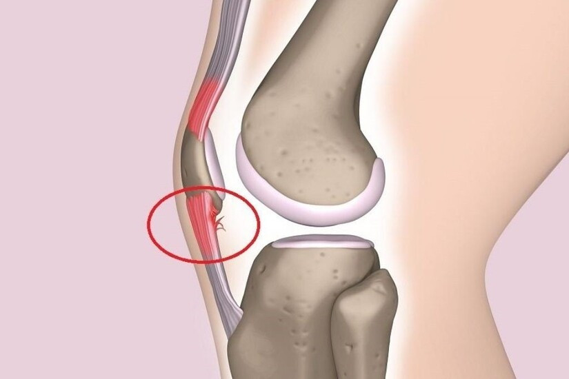 Đau 1 bên đầu gối