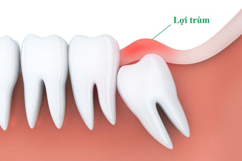 Viêm lợi trùm răng khôn cần điều trị thế nào cho nhanh khỏi? ảnh 1 viêm lợi trùm răng khôn