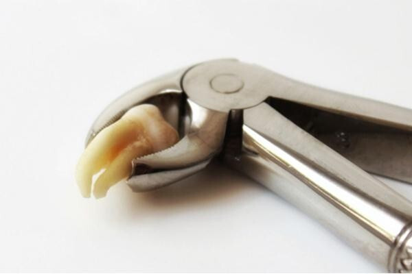 Viêm lợi trùm răng khôn cần điều trị thế nào cho nhanh khỏi? ảnh 3 viêm lợi trùm răng khôn