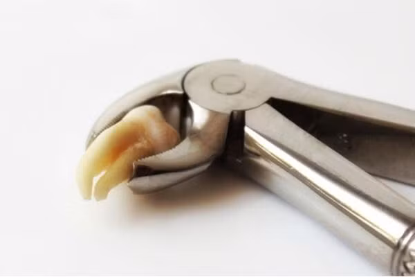 viêm lợi trùm răng khôn