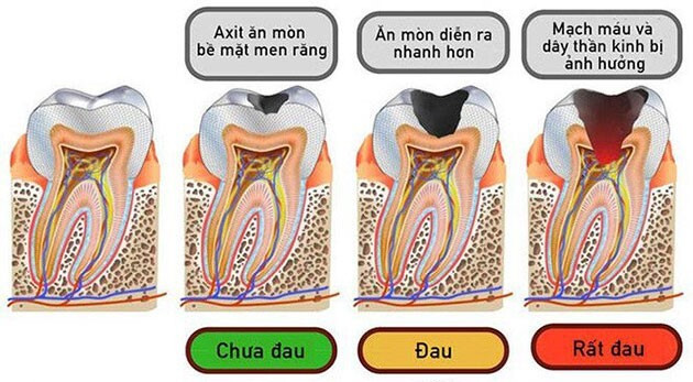 sâu răng ở người lớn