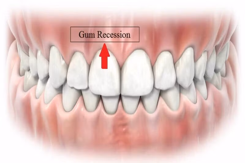 ê buốt răng hàm