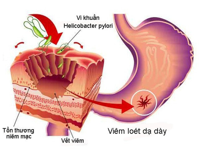 Tìm hiểu các phương pháp điều trị viêm dạ dày HP hiệu quả ảnh 1 Viêm dạ dày HP