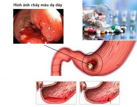 Xung huyết dạ dày là gì, những điều nguy hiểm ít người biết ảnh 1 xung huyết dạ dày là gì
