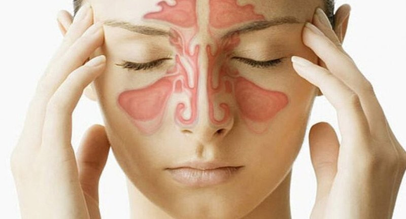 Cách phân biệt nhức đầu do viêm xoang và đau nửa đầu ảnh 2 nhức đầu do viêm xoang