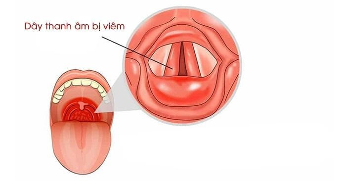 Đau họng sốt cảnh báo bệnh gì, có nguy hiểm không? ảnh 2 đau họng sốt