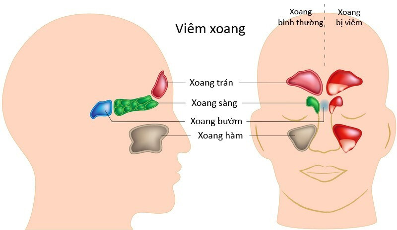Giải pháp cho tình trạng viêm xoang gây ho kéo dài ảnh 1 viêm xoang gây ho