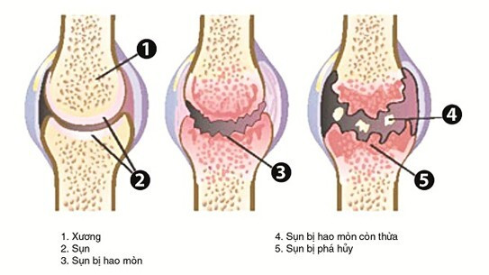 thoái hóa khớp gối