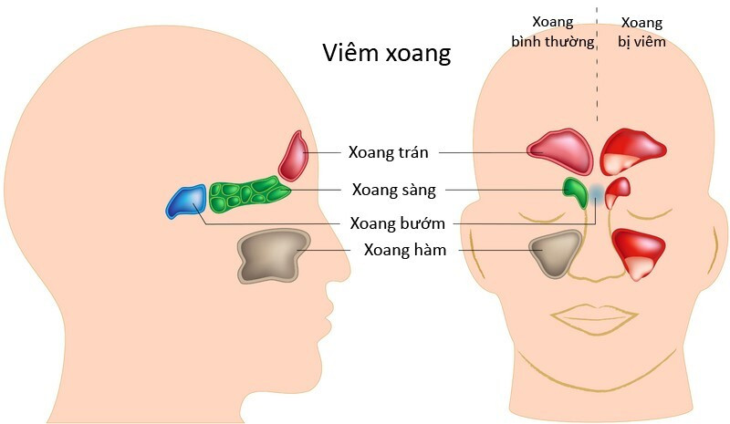 Ngạc nhiên với những món ăn trị viêm xoang vừa ngon vừa tốt ảnh 1 món ăn trị viêm xoang
