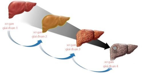 Người bị xơ gan độ 3 sống được bao lâu? ảnh 1 xơ gan độ 3