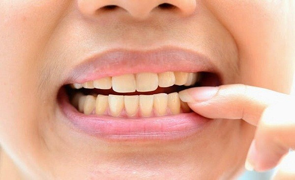 Ăn chua bị ê răng phải làm sao để bảo vệ răng miệng hiệu quả? ảnh 2 Ăn chua bị ê răng