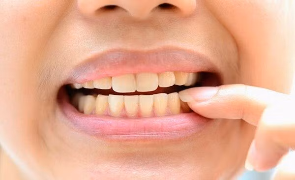 Ăn chua bị ê răng