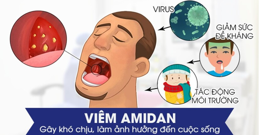 viêm amidan có mủ