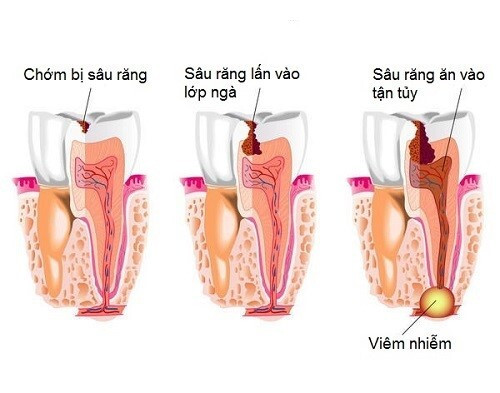 Sâu răng vào tủy