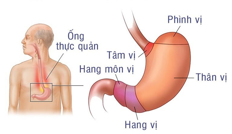 Làm thế nào điều trị dứt điểm viêm hang vị dạ dày? ảnh 1 viêm hang vị dạ dày
