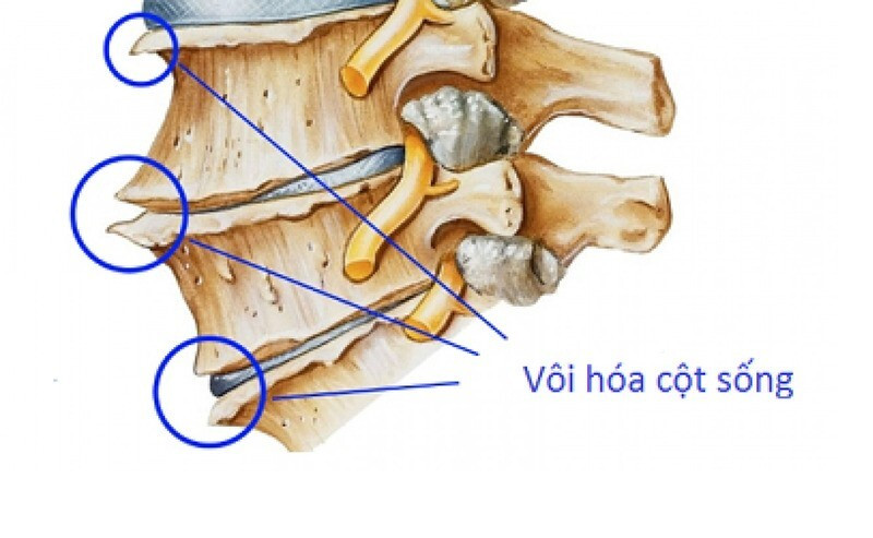 Vôi hóa cột sống nguy hiểm thế nào, điều trị ra sao? ảnh 1 vôi hóa cột sống