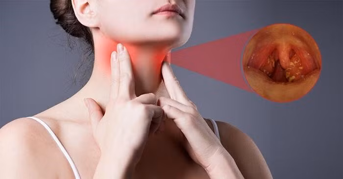 đau rát cổ họng