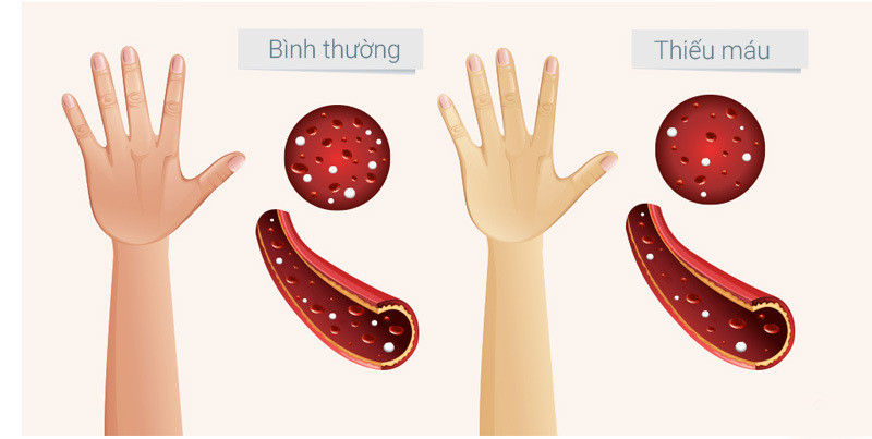 Nguyên nhân gây thiếu máu thiếu sắt và chế độ ăn phù hợp ảnh 1 Thiếu máu do thiếu sắt