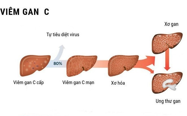 Viêm gan C: Nguyên nhân, dấu hiệu, điều trị và phòng ngừa ảnh 1 viêm gan C