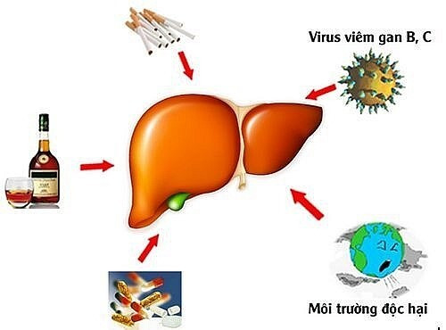 Suy gan có hồi phục hoàn toàn được không? ảnh 1 suy gan có hồi phục được không
