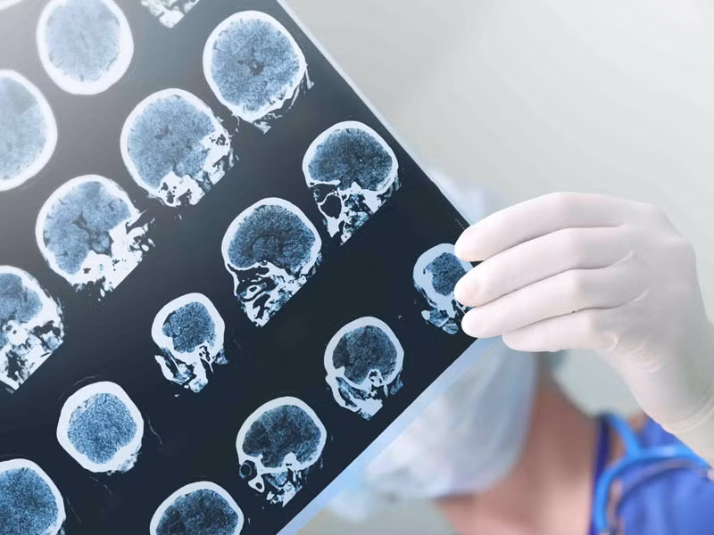 thiếu máu lên não