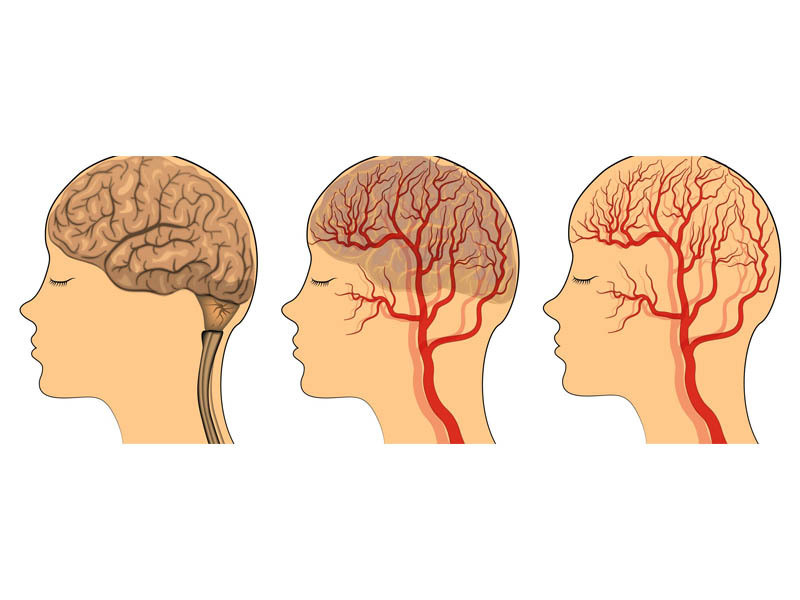 thiếu máu lên não