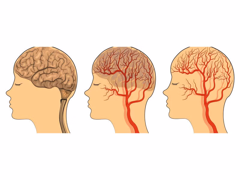 thiếu máu lên não