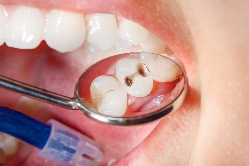 sâu răng gây hôi miệng