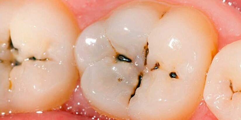 sâu răng gây hôi miệng