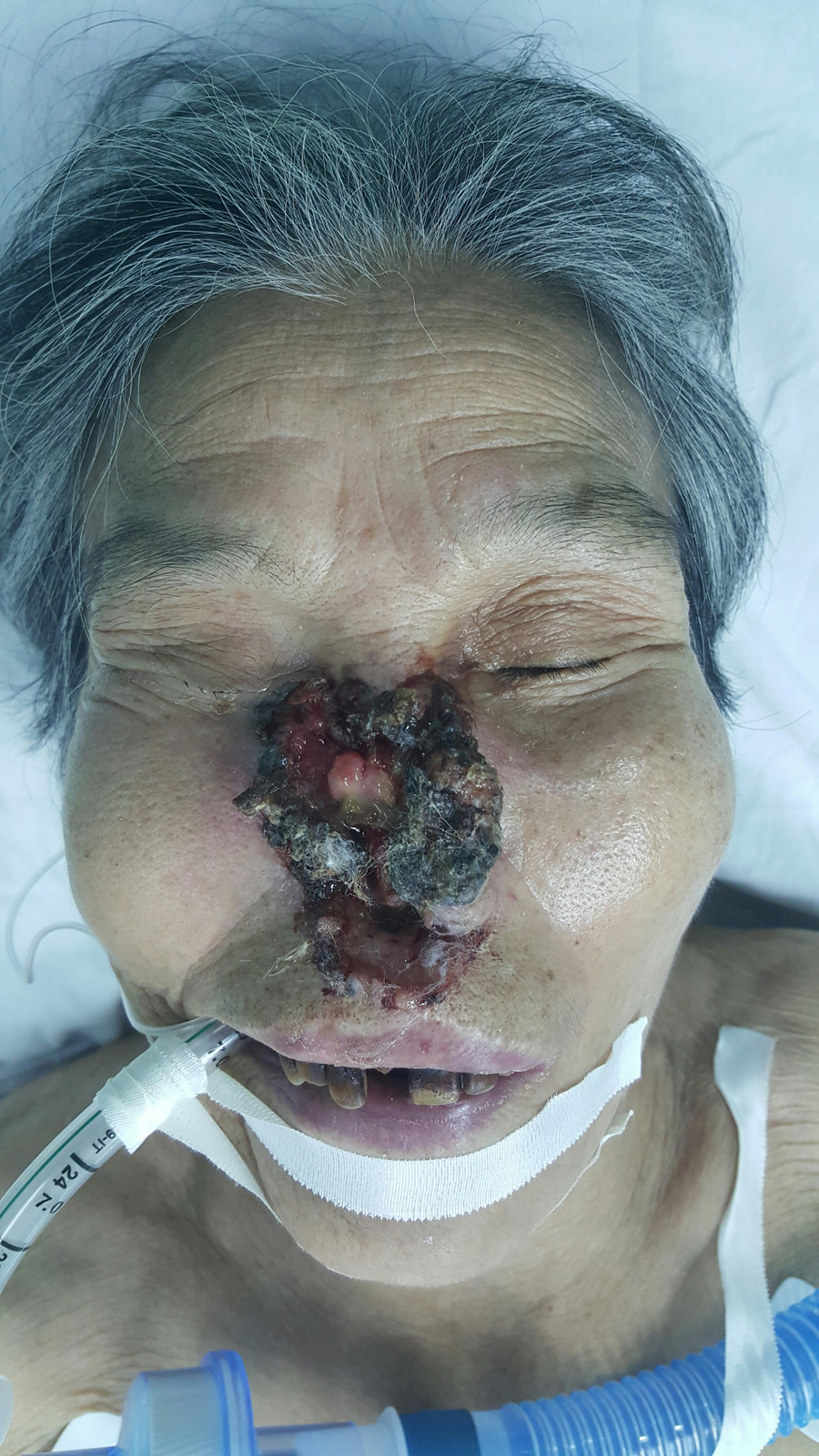 BN Nguyễn Thị Th. đang làm phẫu thuật, ảnh do ThS.Bs.Lê Hồng Phúc cung cấp BN Nguyễn Thị Th. đang làm phẫu thuật, ảnh do ThS.Bs.Lê Hồng Phúc cung cấp