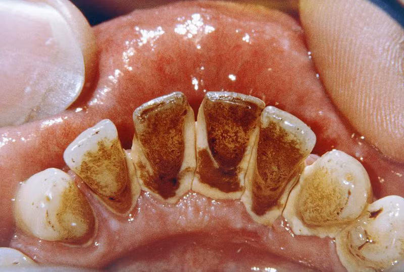 Ngậm thứ này 2 phút trước đi ngủ cao răng tróc ra từng mảng, sạch bay hôi miệng ảnh 1