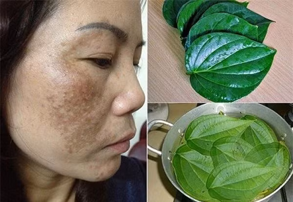 mat-nhieu-dom-den-da-xam-xit-la-do-ban-chua-biet-4-cach-tri-nam-tan-nhang-nay-3-1583914341-259-width600height414