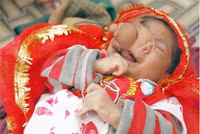 Em bé mới sinh có mũi 