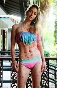 Người đẹp “quái vật” tự tin khoe cơ thể 97% là vẩy nến ảnh 1 Người đẹp “quái vật” tự tin khoe cơ thể 97% là vẩy nến ảnh 1